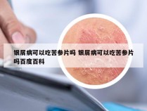 银屑病可以吃苦参片吗 银屑病可以吃苦参片吗百度百科