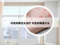 红色的癣怎么治疗 红色的癣是什么