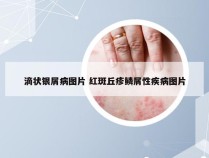 滴状银屑病图片 红斑丘疹鳞屑性疾病图片