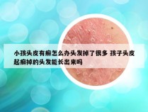 小孩头皮有癣怎么办头发掉了很多 孩子头皮起癣掉的头发能长出来吗