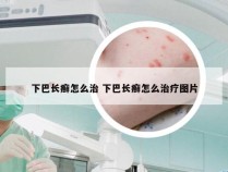 下巴长癣怎么治 下巴长癣怎么治疗图片