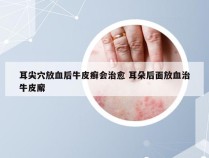 耳尖穴放血后牛皮癣会治愈 耳朵后面放血治牛皮廨