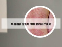 银屑病首选治疗 银屑病的治疗用药