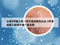 小孩4岁腿上有一块干皮的癣怎么办 4岁宝宝腿上皮肤干燥一直去抓