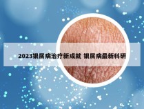 2023银屑病治疗新成就 银屑病最新科研