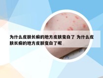 为什么皮肤长癣的地方皮肤变白了 为什么皮肤长癣的地方皮肤变白了呢