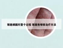 银翘病图片整个过程 银翘有哪些治疗方法