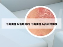 干癣用什么治最好的 干癣用什么药治好得快