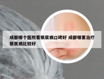 成都哪个医院看银屑病口碑好 成都哪里治疗银屑病比较好