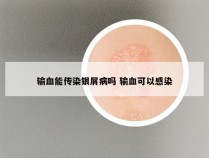 输血能传染银屑病吗 输血可以感染