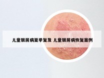 儿童银屑病夏季复发 儿童银屑病恢复案例