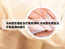 马哈婴乐霜能治疗银屑病吗 马哈婴乐霜能治疗银屑病吗图片