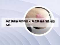 牛皮肤癣会传染吗图片 牛皮肤癣会传染给他人吗