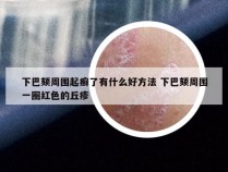 下巴颏周围起癣了有什么好方法 下巴颏周围一圈红色的丘疹