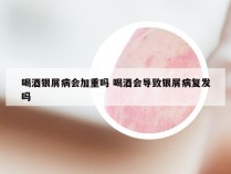 喝酒银屑病会加重吗 喝酒会导致银屑病复发吗