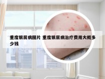 重度银屑病图片 重度银屑病治疗费用大概多少钱