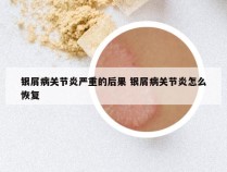 银屑病关节炎严重的后果 银屑病关节炎怎么恢复