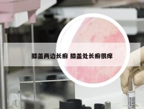 膝盖两边长癣 膝盖处长癣很痒