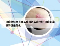 体癣急性期有什么症状怎么治疗好 体癣的发病特征是什么