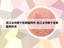 浙江义乌哪个皮肤医院好 浙江义乌哪个皮肤医院好点