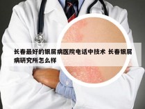 长春最好的银屑病医院电话中技术 长春银屑病研究所怎么样