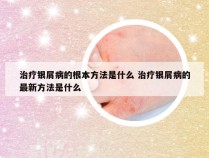 治疗银屑病的根本方法是什么 治疗银屑病的最新方法是什么