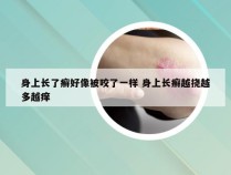 身上长了癣好像被咬了一样 身上长癣越挠越多越痒