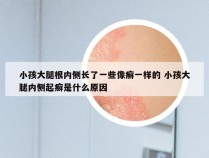 小孩大腿根内侧长了一些像癣一样的 小孩大腿内侧起癣是什么原因