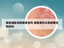 银屑病能用硫磺香皂吗 银屑病可以用硫磺洗剂洗吗