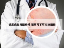 银屑病能用酒精吗 银屑可不可以擦酒精