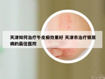 天津如何治疗牛皮癣效果好 天津市治疗银屑病的最佳医院