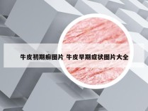 牛皮初期癣图片 牛皮早期症状图片大全