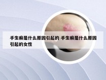 手生癣是什么原因引起的 手生癣是什么原因引起的女性