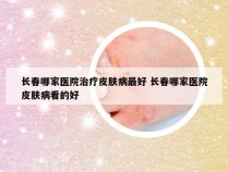 长春哪家医院治疗皮肤病最好 长春哪家医院皮肤病看的好