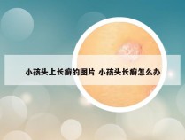 小孩头上长癣的图片 小孩头长癣怎么办