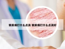 银屑病打什么点滴 银屑病打什么点滴好