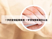 一岁的宝宝起银屑病 一岁宝宝银屑病怎么治