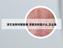 泽它洗剂对银屑病 泽银洗剂是什么,怎么用