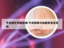 牛皮癣并发糖尿病 牛皮肤癣与血糖高有关系吗