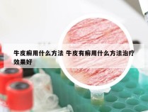 牛皮癣用什么方法 牛皮有癣用什么方法治疗效果好