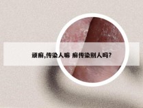 顽癣,传染人嘛 癣传染别人吗?