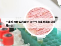 牛皮癣用什么药膏好 治疗牛皮皮癣最好药膏是什么