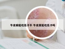 牛皮癣能吃瓜子不 牛皮屑能吃瓜子吗