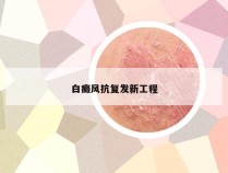 白癜风抗复发新工程