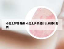 小腿上好像有癣 小腿上长癣是什么原因引起的