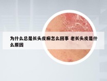 为什么总是长头皮癣怎么回事 老长头皮是什么原因