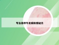 专治各种牛皮癣除根秘方