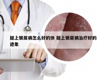 腿上银屑病怎么好的快 腿上银屑病治疗好的迹象