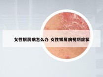 女性银屑病怎么办 女性银屑病初期症状