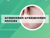 治疗银屑的生物制剂 治疗银屑病的生物制剂的性价比排名